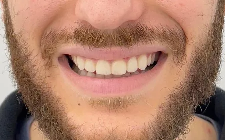 After treatment — Dental veneers