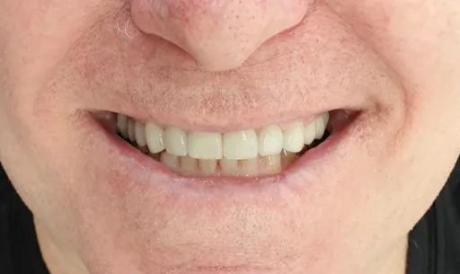 After treatment — Aesthetic rehabilitation