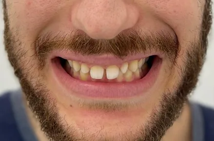 Before treatment — Dental veneers
