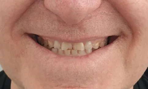 Before treatment — Aesthetic rehabilitation