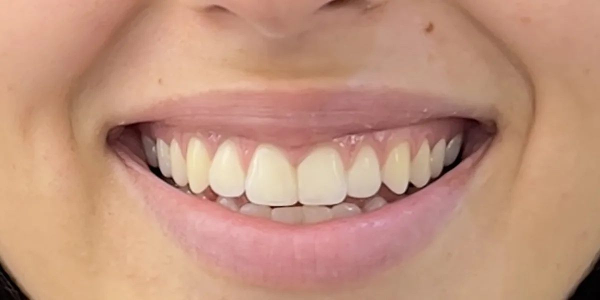 After treatment: Cosmetic tooth build-up (patient of the clinic)