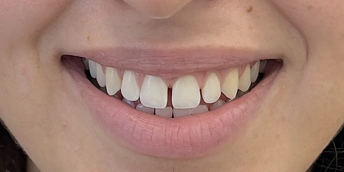 Before treatment: Cosmetic tooth build-up (patient of the clinic)