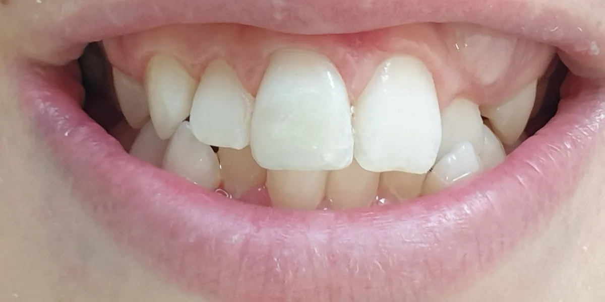 After treatment: Broken tooth repaired (patient of the clinic)