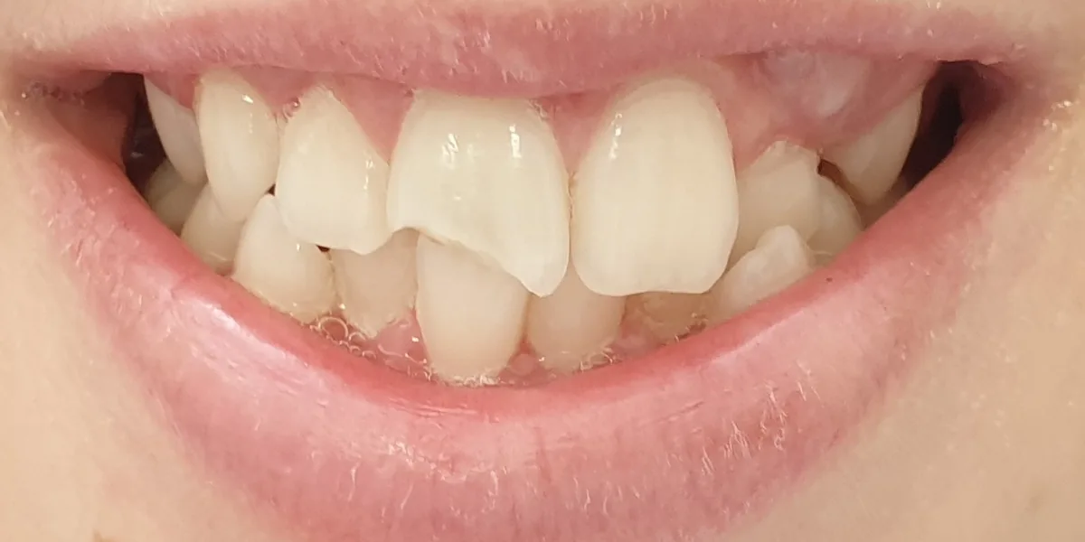Before treatment: Broken tooth repaired (patient of the clinic)