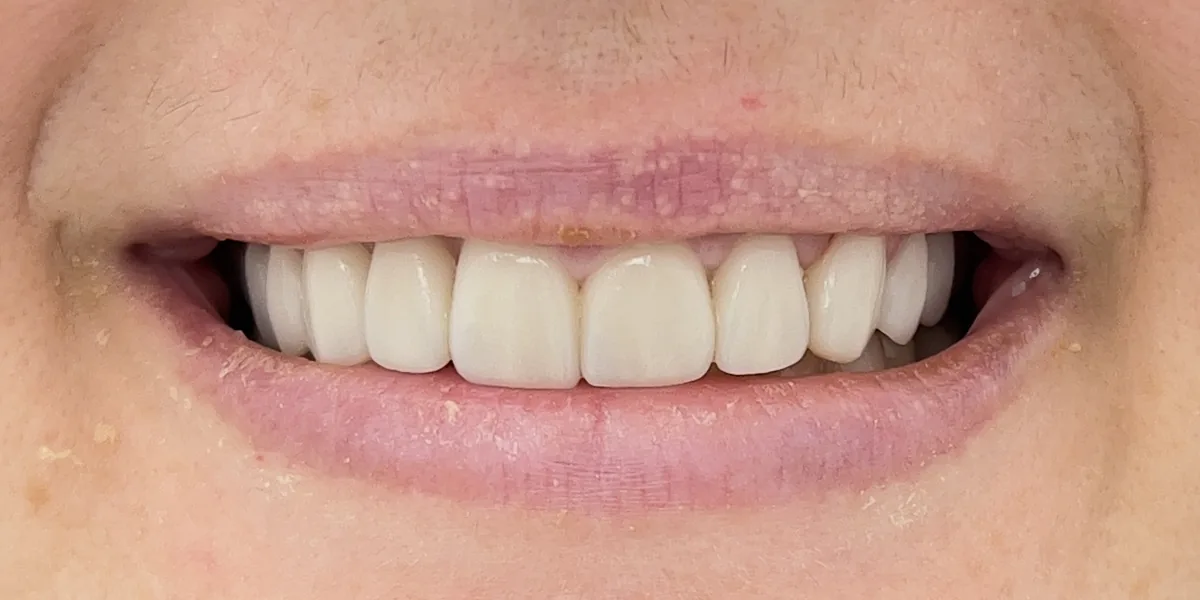 After treatment: Dental veneers (patient of the clinic)