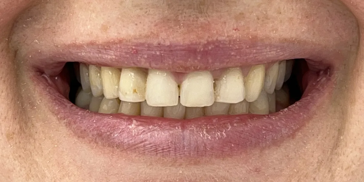 Before treatment: Dental veneers (patient of the clinic)