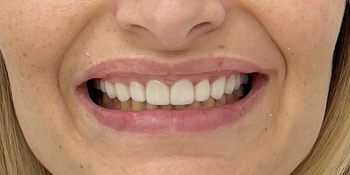 After treatment: Dental veneers (patient of the clinic)