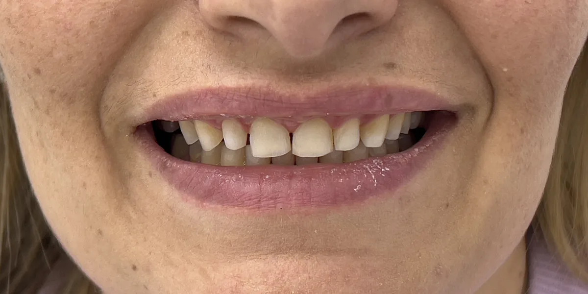 Before treatment: Dental veneers (patient of the clinic)