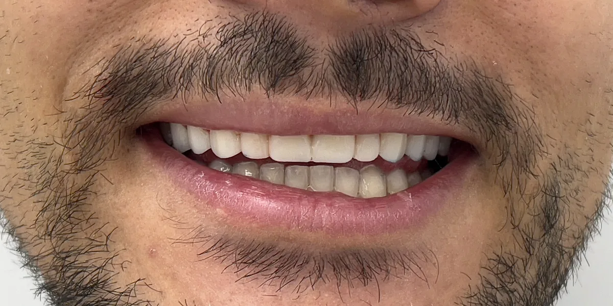 After treatment: Dental veneers (patient of the clinic)