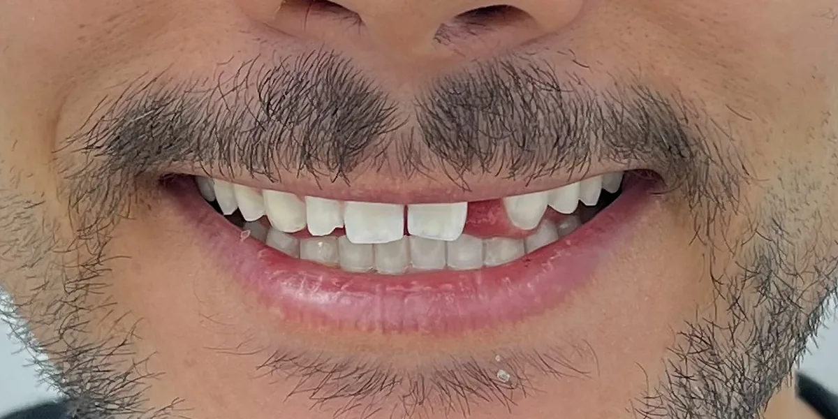Before treatment: Dental veneers (patient of the clinic)