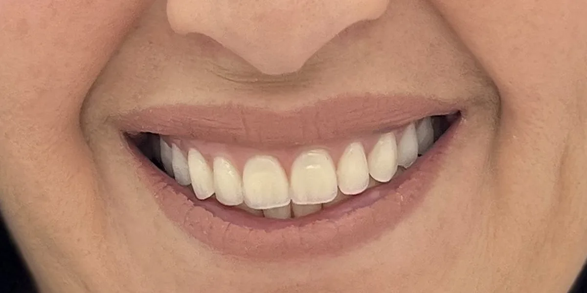 After treatment: Full-arch restoration on implants (patient of the clinic)