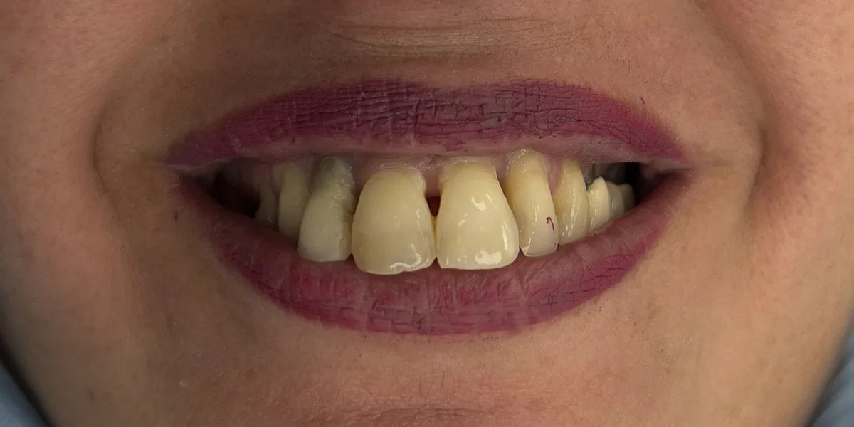 Before treatment: Full-arch restoration on implants (patient of the clinic)