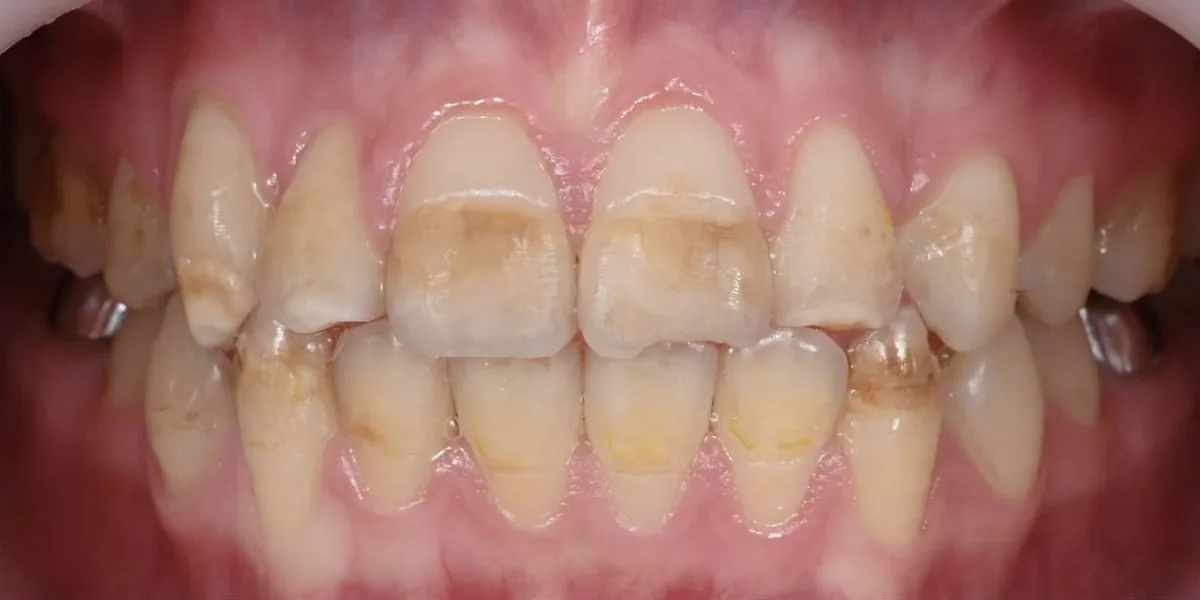 Before treatment: Damaged enamel restored with nano-composite (patient of the clinic)