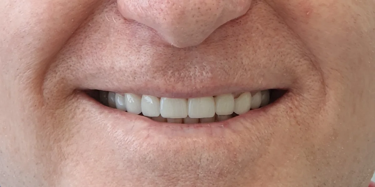 After treatment: Zirconia crowns (patient of the clinic)