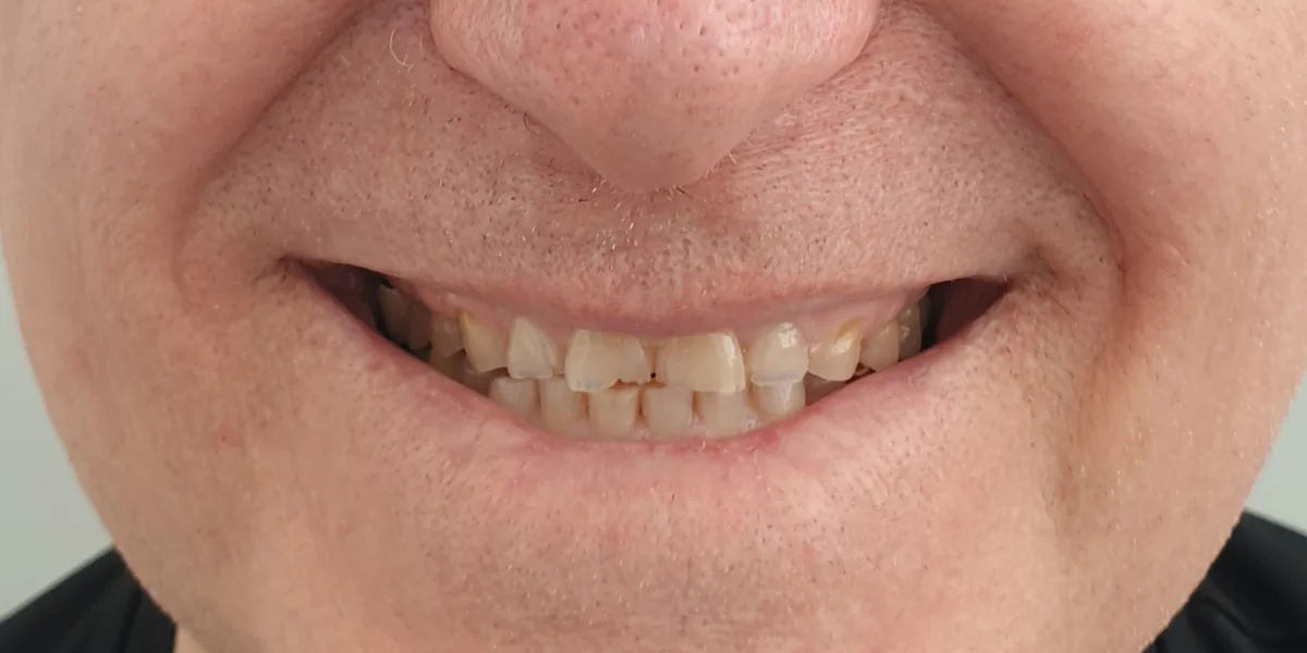 Before treatment: Zirconia crowns (patient of the clinic)