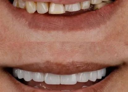 Case from the clinic: teeth before and after veneers