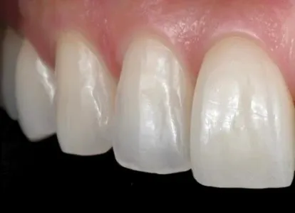 Close-up of veneers on the front teeth