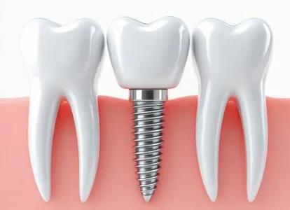 3D illustration of a dental implant between two natural teeth
