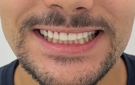 Man smiling with even front teeth