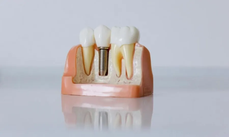 Temporary crown protecting a prepared tooth