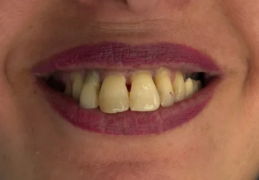 Before — Full rehabilitation on implants