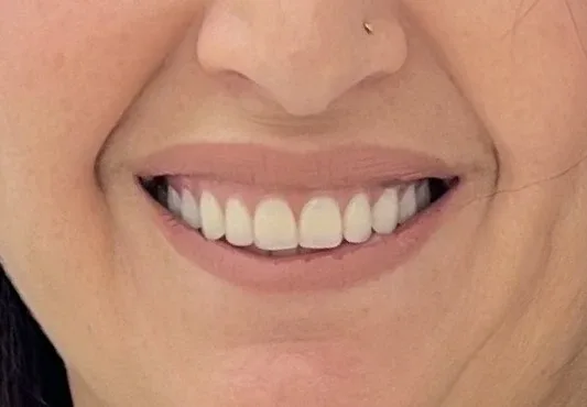 After — Full rehabilitation on implants