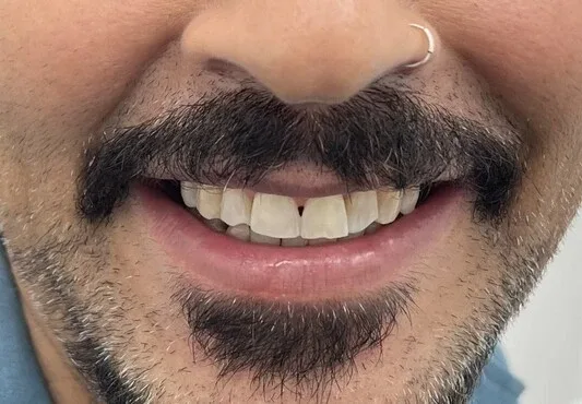 Before — Full rehabilitation with veneers