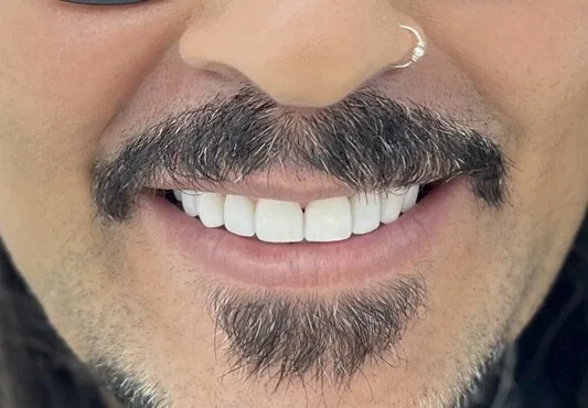 After — Full rehabilitation with veneers